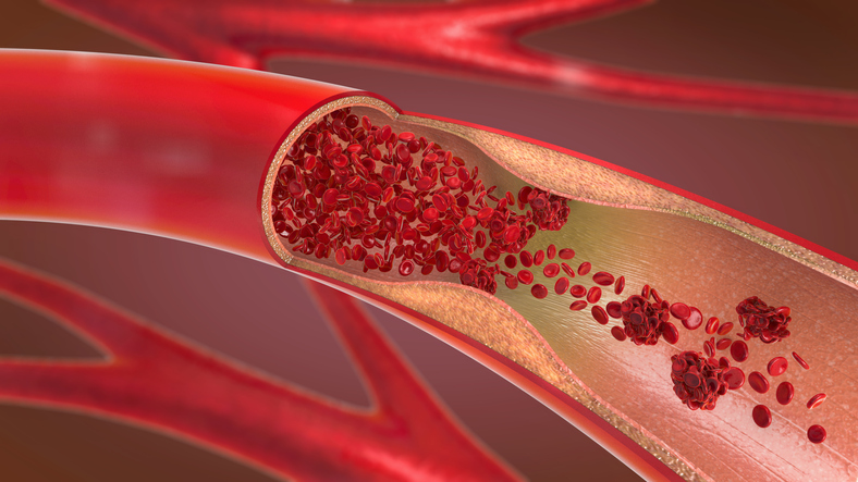 Blood Flow Restriction Treatment